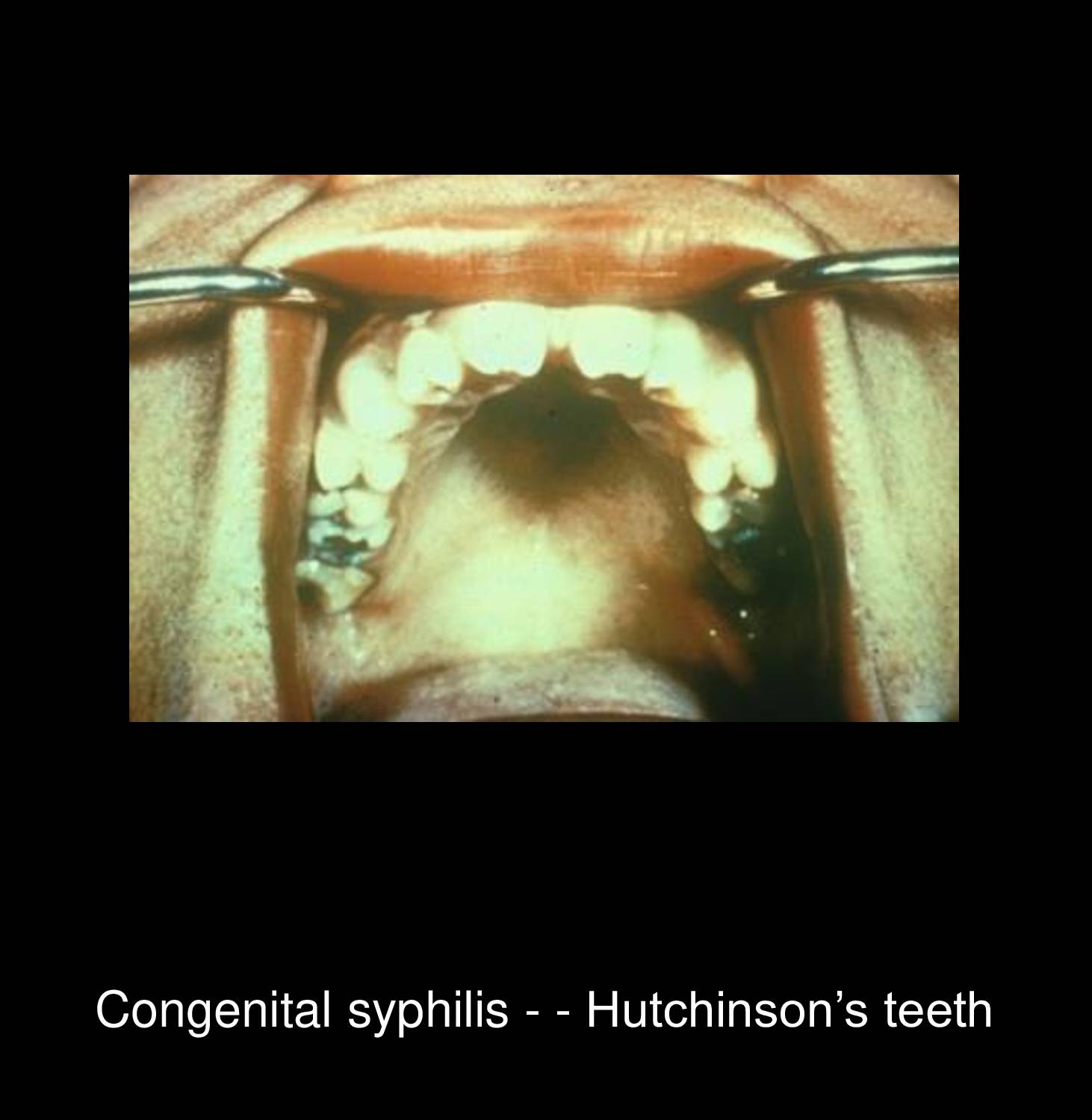 Secondary syphilis generalized lymphadenopathy with multiple enlarged firm non-tender lymph nodes in cervical axillary and inguinal regions